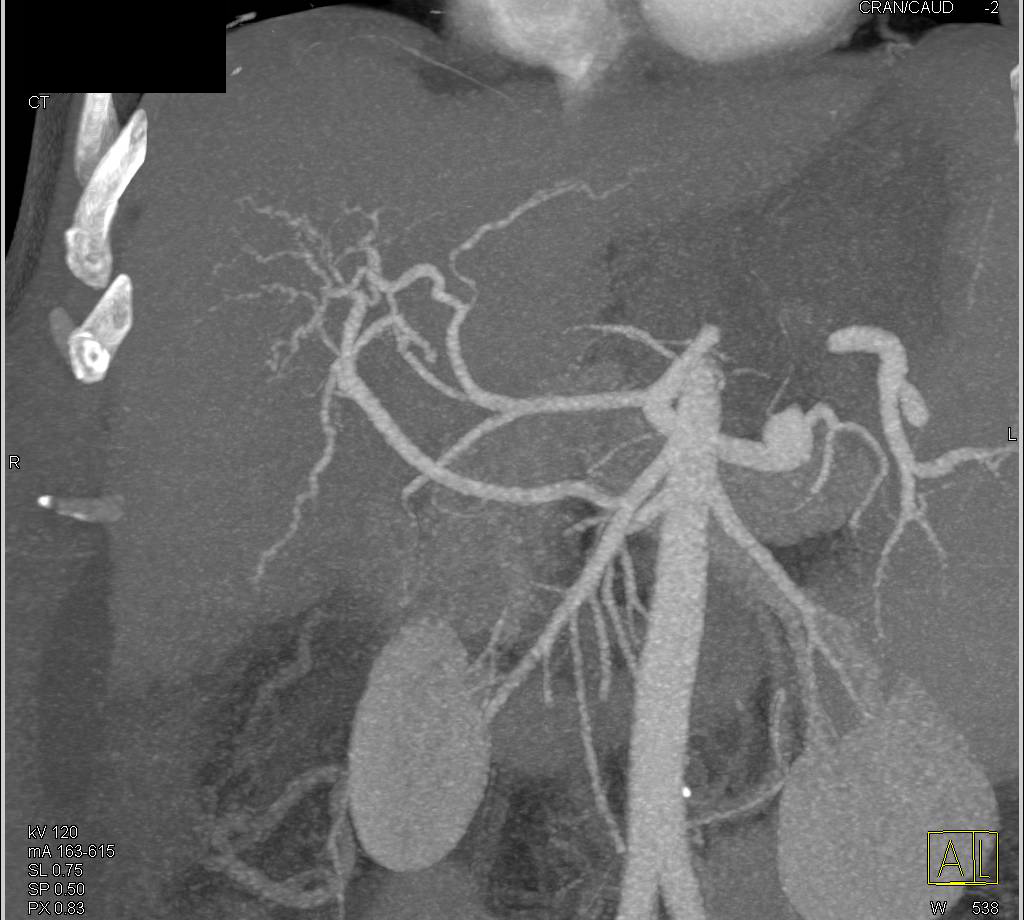 Cirrhosis with Irregular Branching of the Hepatic Artery Branches - CTisus CT Scan