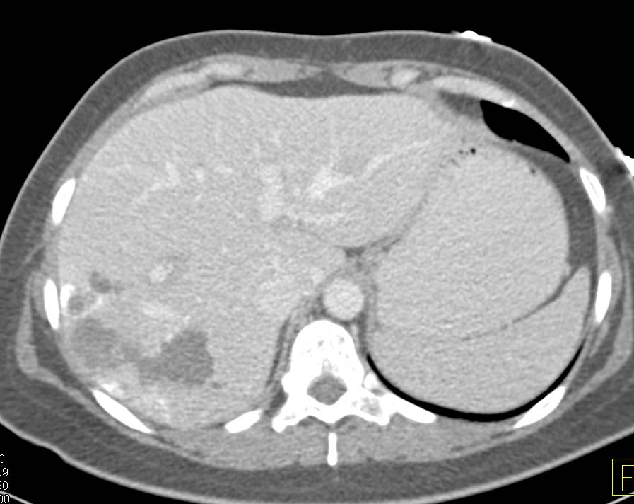 Prior Embolization of a Hepatic Metastases - CTisus CT Scan