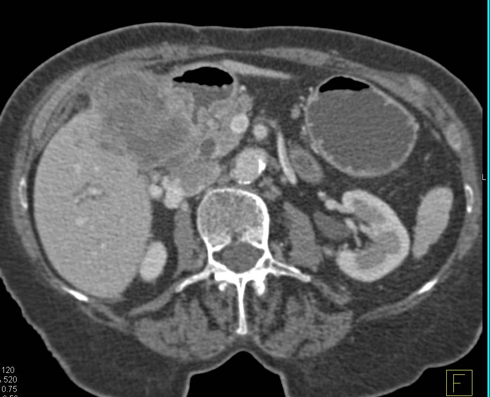 Gallbladder Cancer Invades the Liver with Liver Metastases - CTisus CT Scan