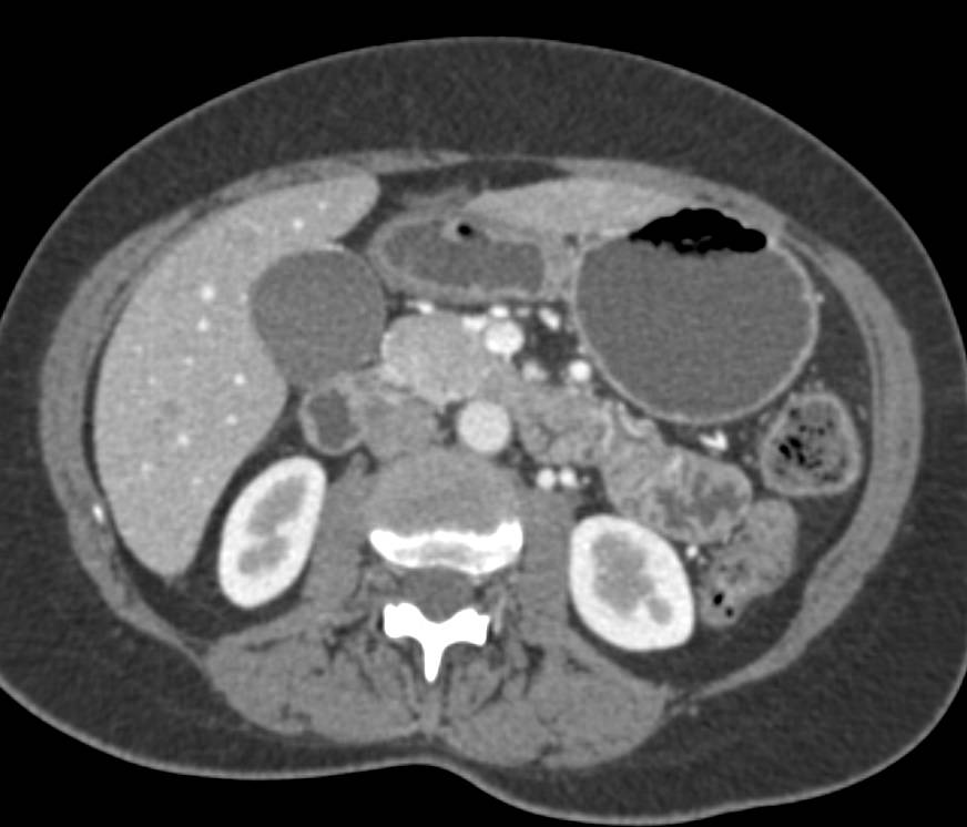 Hepatic Adenoma - CTisus CT Scan