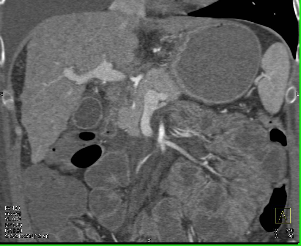 Macronodular Cirrhosis of the Liver with Portal Hypertension - CTisus CT Scan
