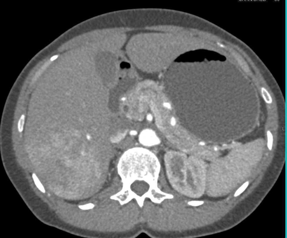 Hepatocellular Carcinoma (Hepatoma) in a Non-Cirrhotic Liver - CTisus CT Scan