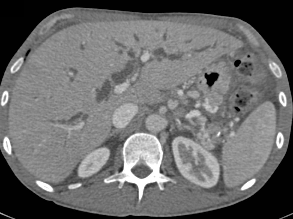 Varices and Portal Hypertension in Patient with Chronic Pancreatitis. Note the Dilated Common Bile Duct (CBD) and Pancreatic Duct - CTisus CT Scan