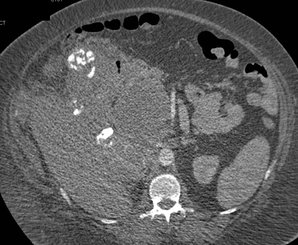 Gallbladder cancer Invades the liver - CTisus CT Scan