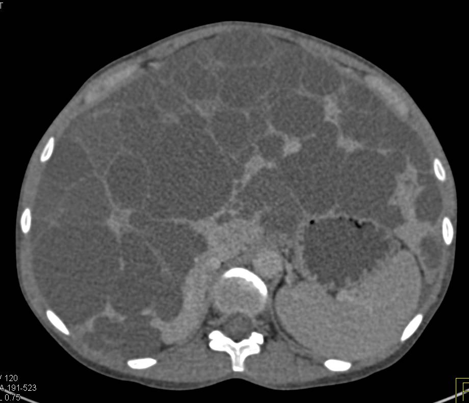 Polycystic Liver and Polycystic Renal Disease - CTisus CT Scan