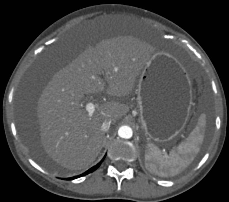 Cirrhosis with Portal Hypertension and Ascites, a Wet Small Bowel Pattern and Prominent Mesenteric Venous Arcade - CTisus CT Scan