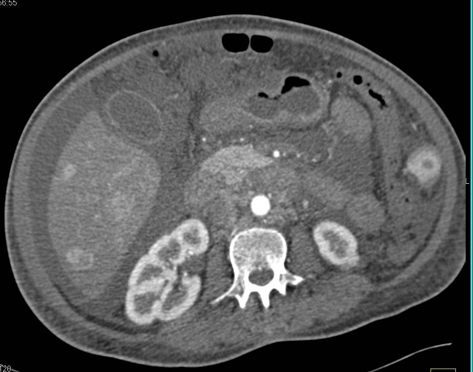 Multifocal Cholangiocarcinoma of the Liver - CTisus CT Scan