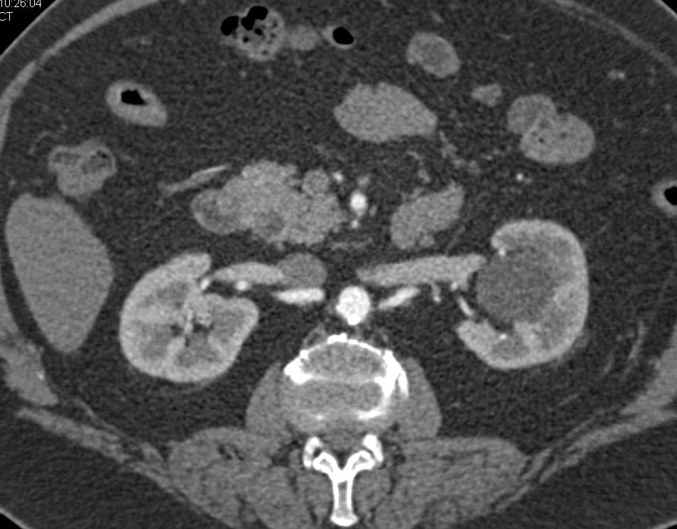 Tumor in Distal Common Bile Duct Seen Best on Coronal Displays - CTisus CT Scan