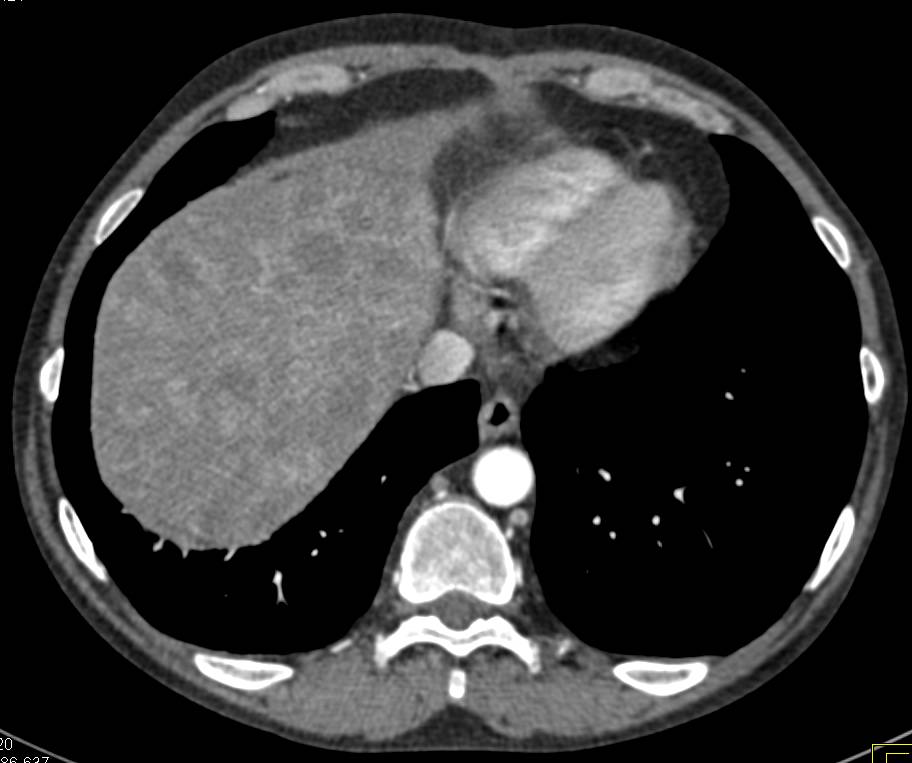 Lymphoma Involves the Liver and Para-Aortic Nodal Chain - CTisus CT Scan