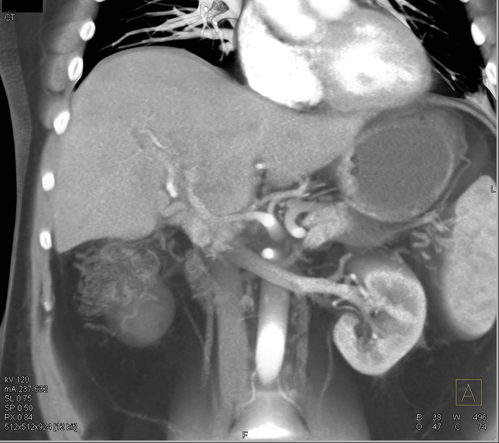 Cholangiocarcinoma with Cavernous Transformation of the Portal Vein - CTisus CT Scan