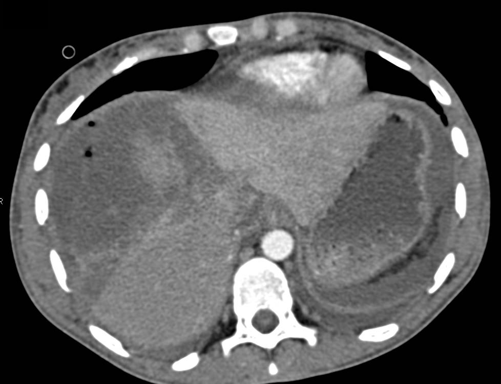 Hepatic Bleed and Subsequent Infarction - CTisus CT Scan