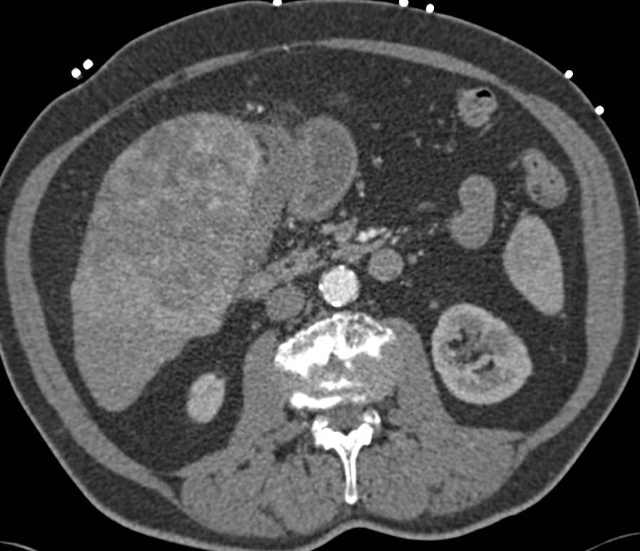 Hepatocellular Carcinoma (Hepatoma) with Neovascularity and Multiphase Display - CTisus CT Scan