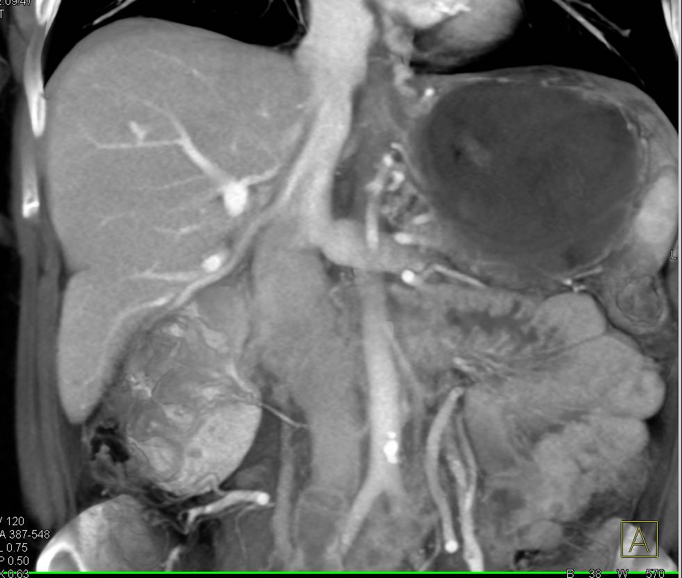 parenchymal-liver-disease