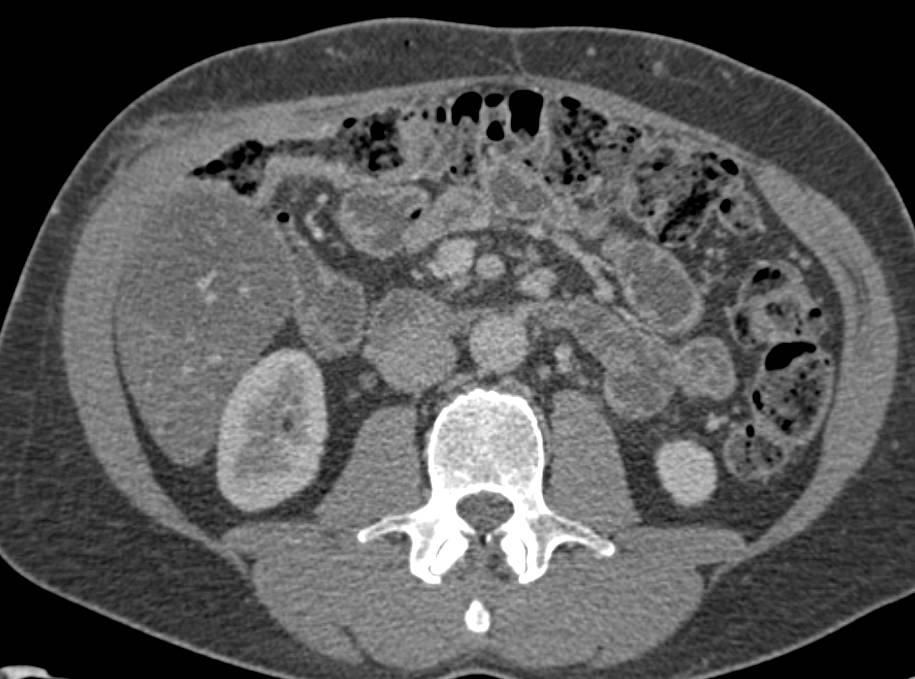 Diffuse Fatty Infiltration of the Liver - CTisus CT Scan