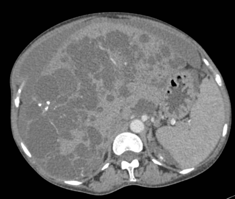 Polycystic Liver and Polycystic Renal Disease with a Failed LLQ Renal Transplant - CTisus CT Scan