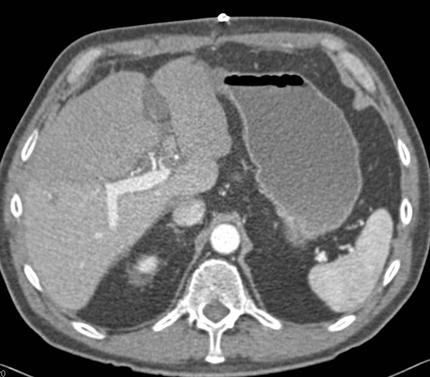 Perfusion Changes in the Liver due to Portal Vein Thrombosis - CTisus CT Scan