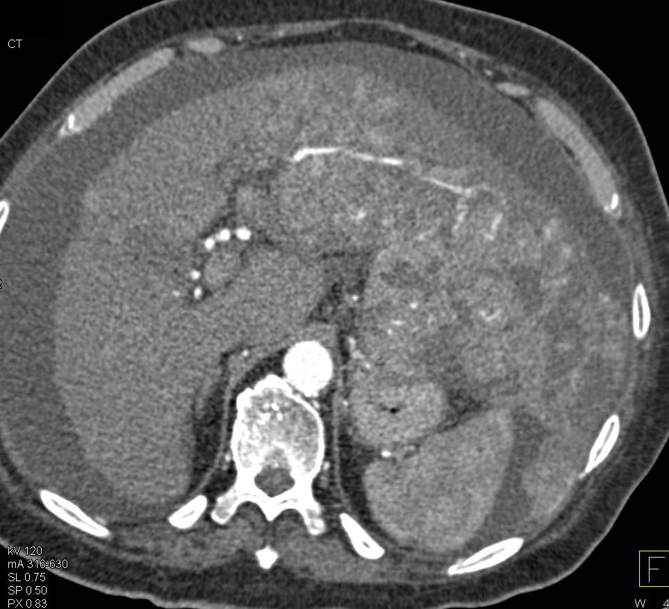 Multifocal Hepatocellular Carcinoma (Hepatoma) with Neovascularity and Multiphase Acquisition with 3D Maps - CTisus CT Scan