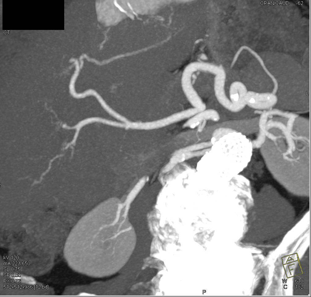 Hepatocellular Carcinoma (Hepatoma) with Neovascularity Arising in a Cirrhotic Liver. Hepatoma also has a Pseudocapsule - CTisus CT Scan