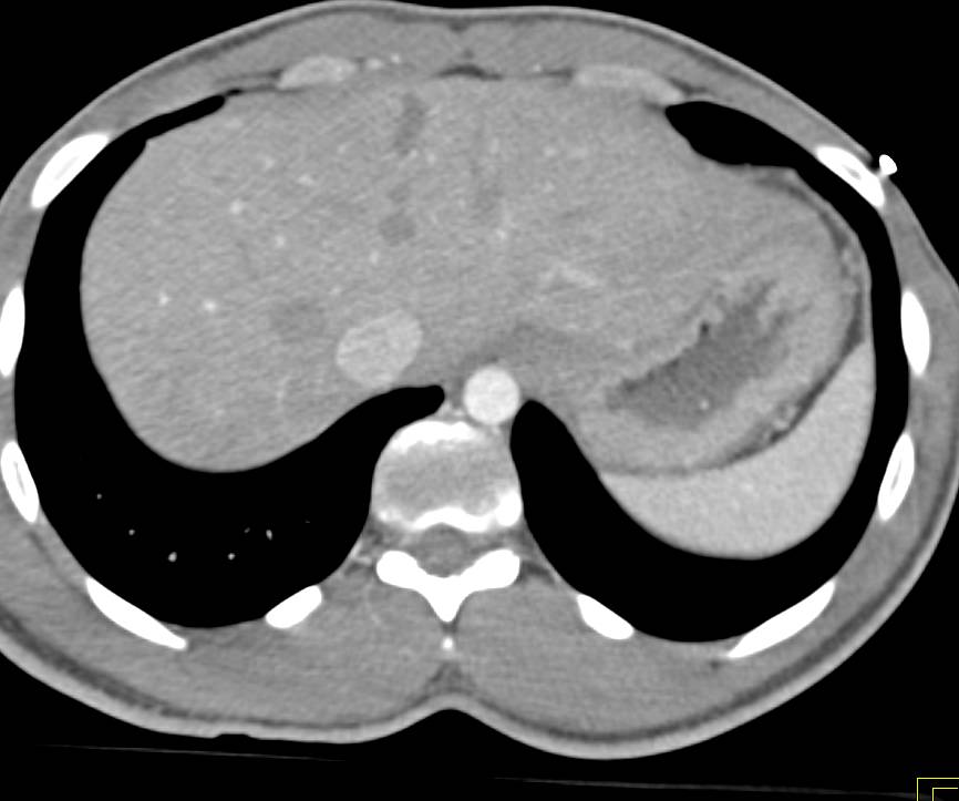 Liver Laceration with Blood in Pelvis - CTisus CT Scan