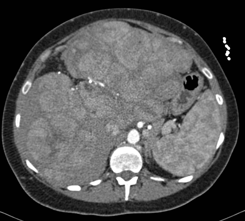 Metastatic Carcinoid Tumor to the Liver with Hypervascular Lesions