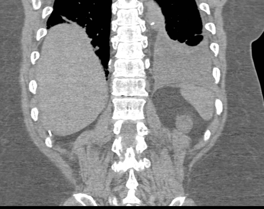 Giant Hemangioma in a Patient with a History of Renal Cell Carcinoma - CTisus CT Scan