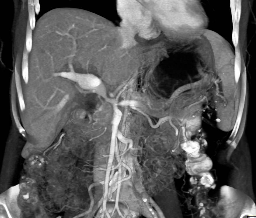 Cholangiocarcinoma Encases the Portal Vein - CTisus CT Scan