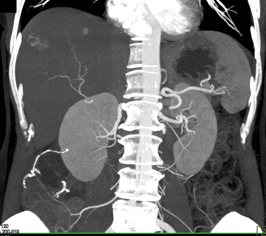 Hemangioma on MIP Images - CTisus CT Scan