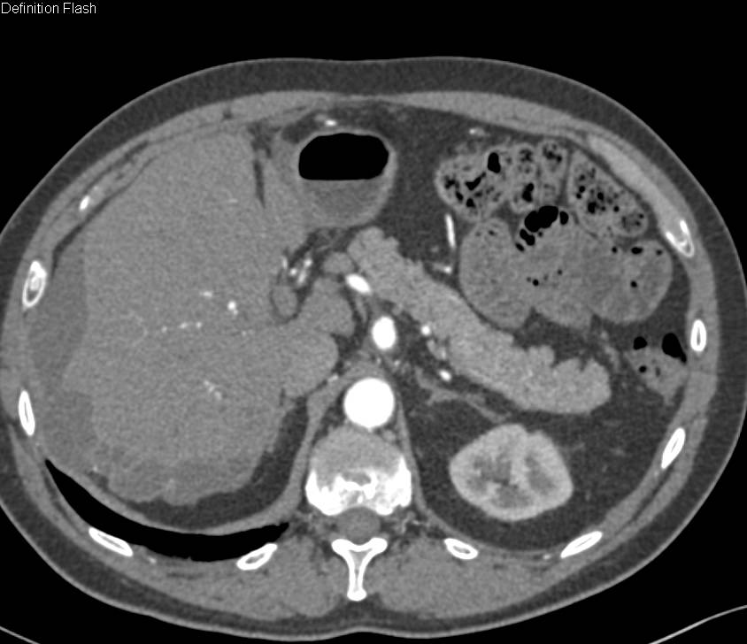 Pseudomyxoma Peritonei (PMP) with Incidental Celiac Artery Aneurysm - CTisus CT Scan