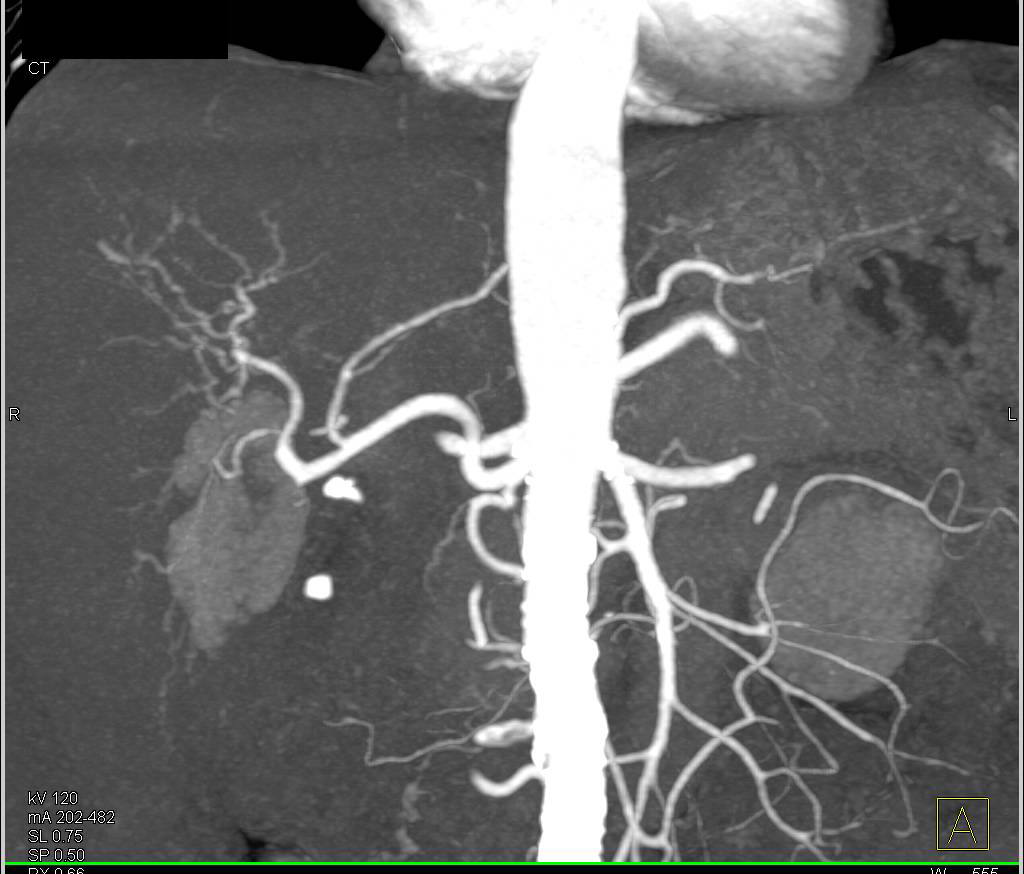 Cirrhosis with Portal Hypertension and Varices in 3D - CTisus CT Scan