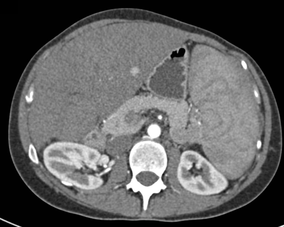 Regenerative Nodules in a Patient with Budd-Chiari Syndrome, Transjugular Intrahepatic Portosystemic Shunt (TIPS) Shunt and Portal Hypertension - CTisus CT Scan