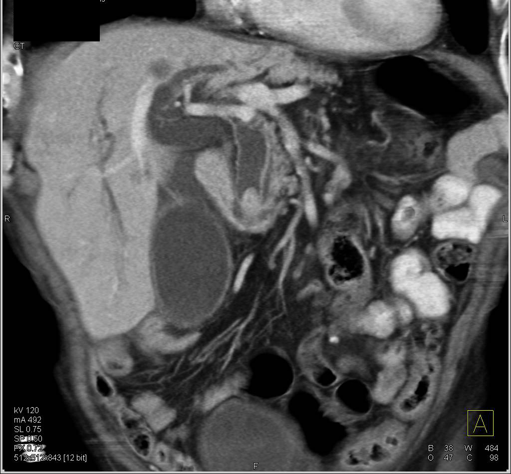 Adenocarcinoma in Distal Common Bile Duct Looks a Bit Like a Stone but Note Liver Metastases and Enhancement of the Lesion - CTisus CT Scan