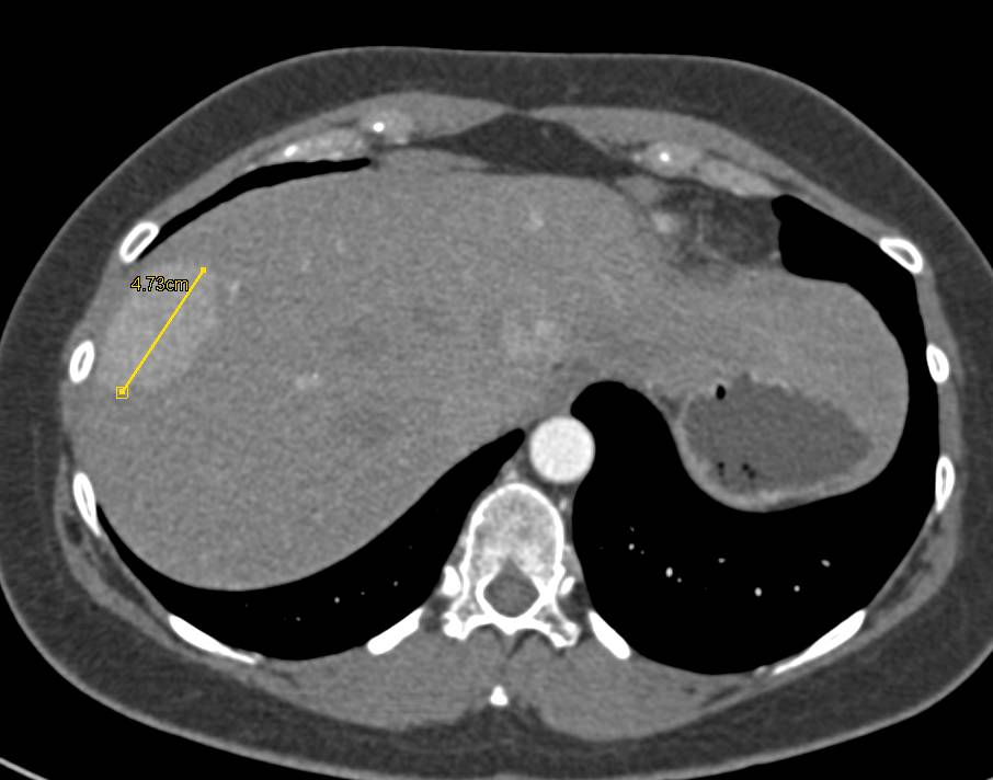 Focal Nodular Hyperplasia (FNH) - Liver Case Studies - CTisus CT Scanning