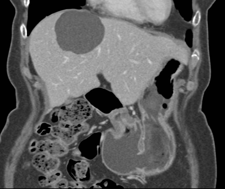 Simple Hepatic Cyst - CTisus CT Scan