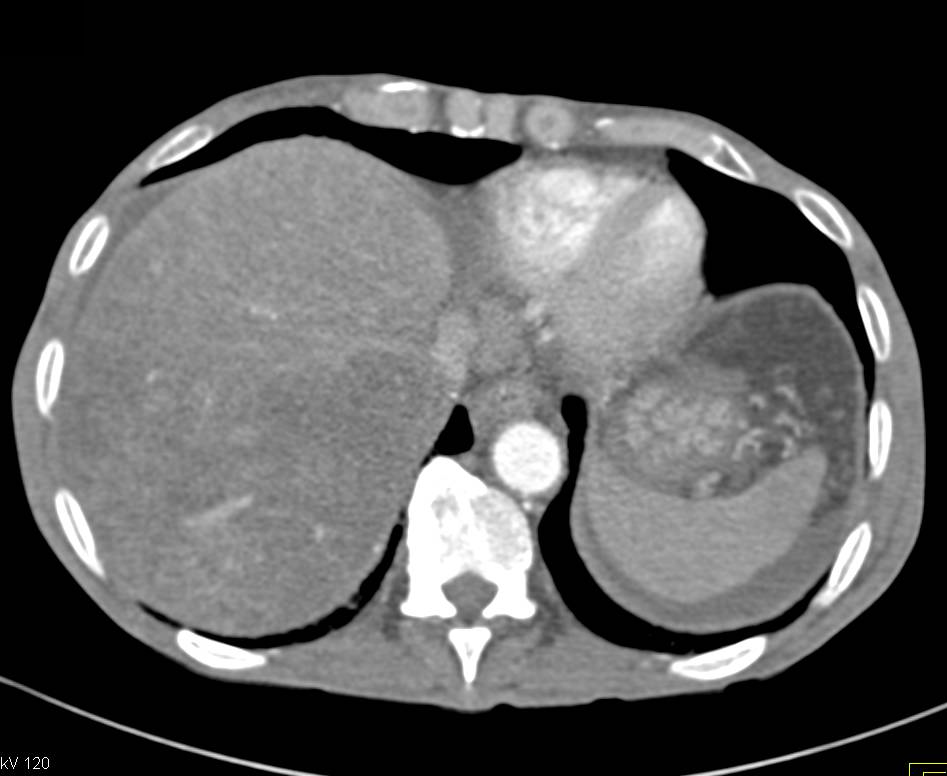 Patchy Enhancement of the Liver in Budd-Chiari Syndrome - CTisus CT Scan