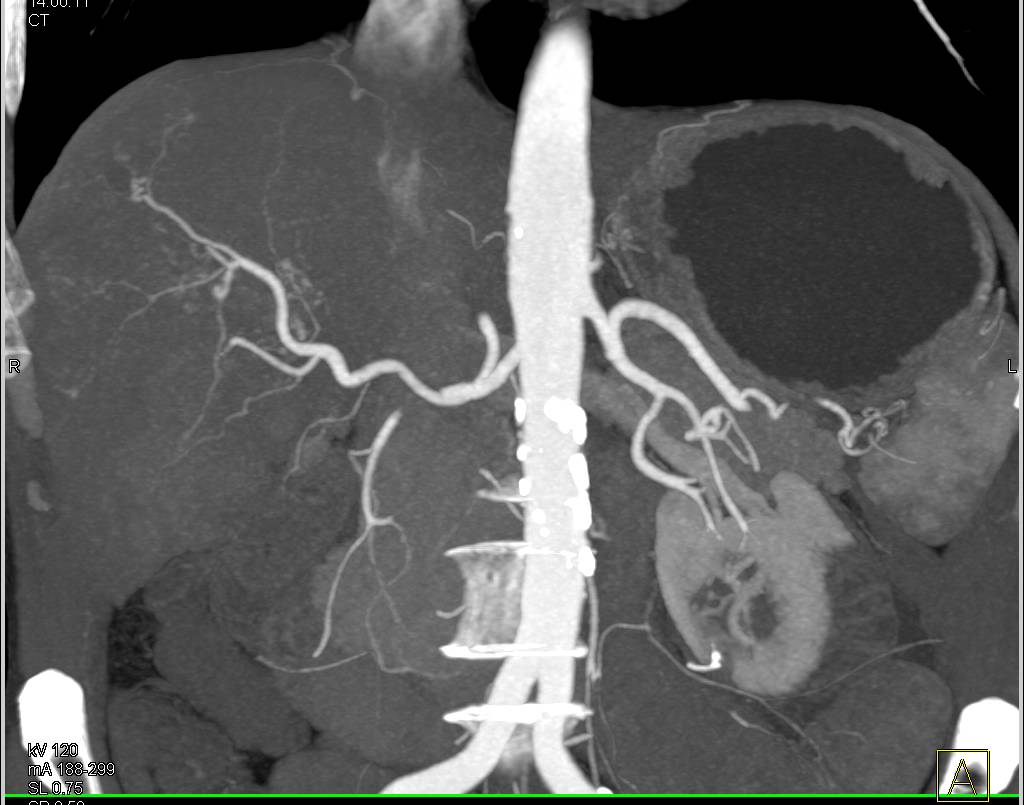 Intrahepatic Cholangiocarcinoma with Portal Vein Invasion - CTisus CT Scan