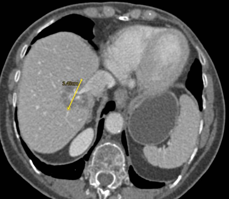 Metastatic Mucinous Colon Cancer to the Liver - CTisus CT Scan
