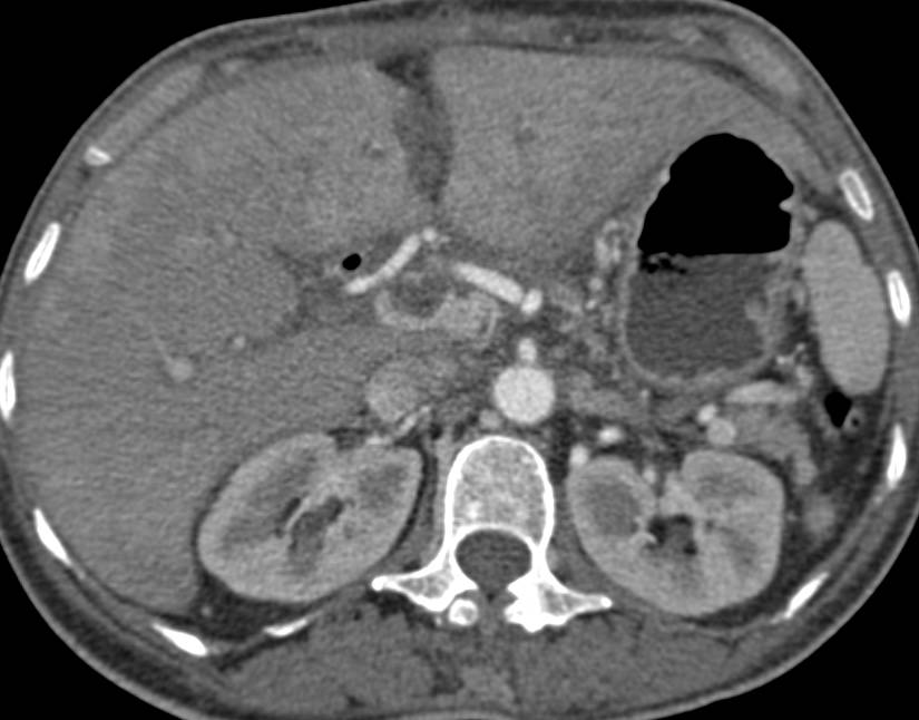 Non-occlusive Portal Vein Thrombosis with Perfusion Changes in the Liver - CTisus CT Scan