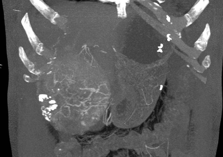 Hepatocellular Carcinoma (Hepatoma) s/p TACE Procedure - CTisus CT Scan