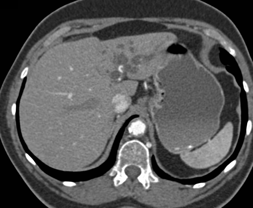 Cholangiocarcinoma Obstructs the Left Ductal System with Left Lobe of Liver Atrophy - CTisus CT Scan