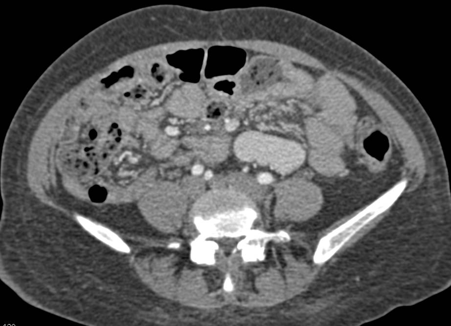 Cirrhosis with Portal Hypertension and Large Varices. Varices in Mesentery Simulate a Mass. - CTisus CT Scan