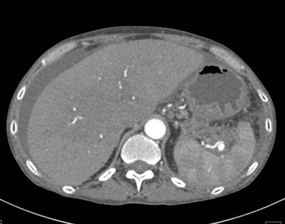 Portal Hypertension with Varices and Splenic Artery Pseudoaneurysm - CTisus CT Scan