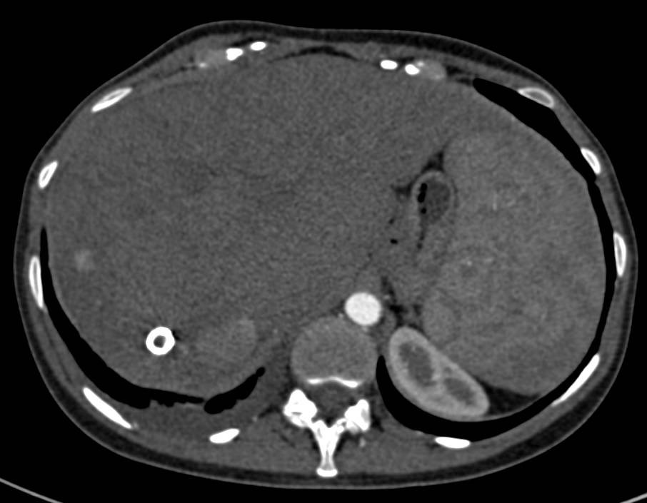 Cirrhosis of the Liver with Regenerative Nodules. Transjugular Intrahepatic Portosystemic Shunt (TIPS) catheter is also seen - CTisus CT Scan