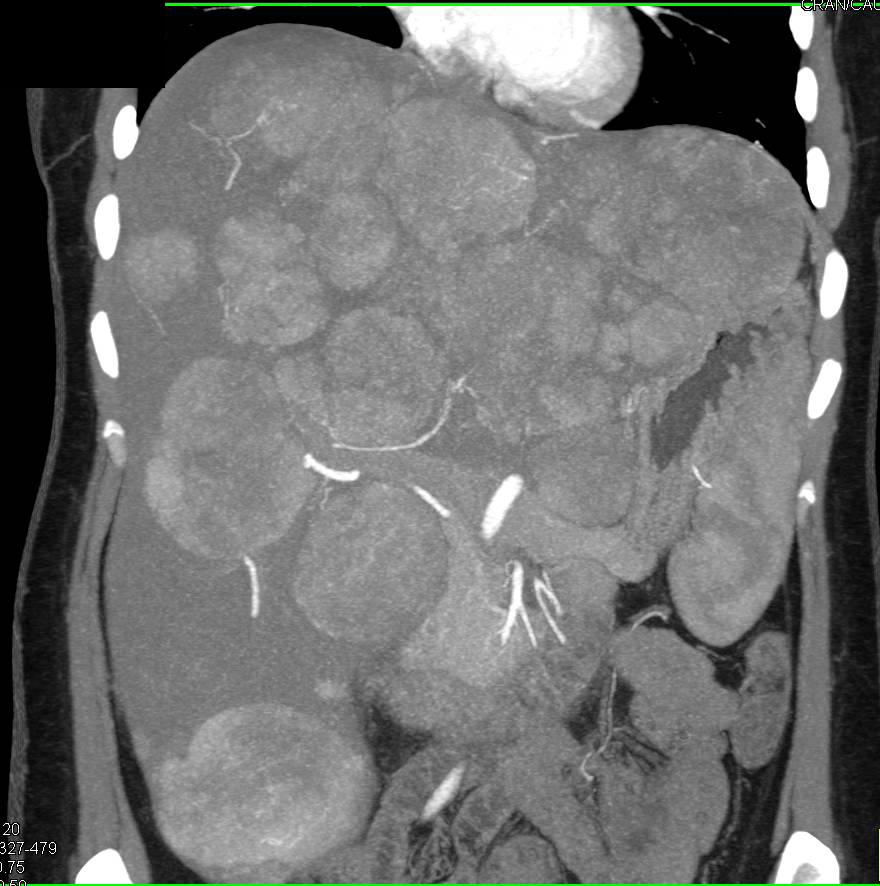 Neuroendocrine Tumor with Extensive Liver Metastases - CTisus CT Scan