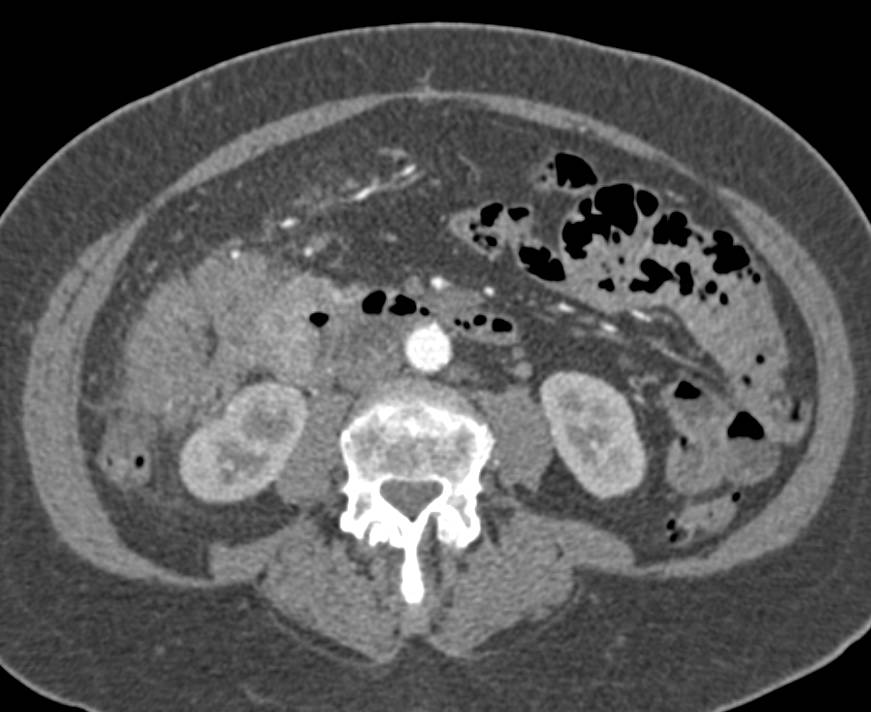 Invasive Gallbladder Cancer Involves the Colon - CTisus CT Scan