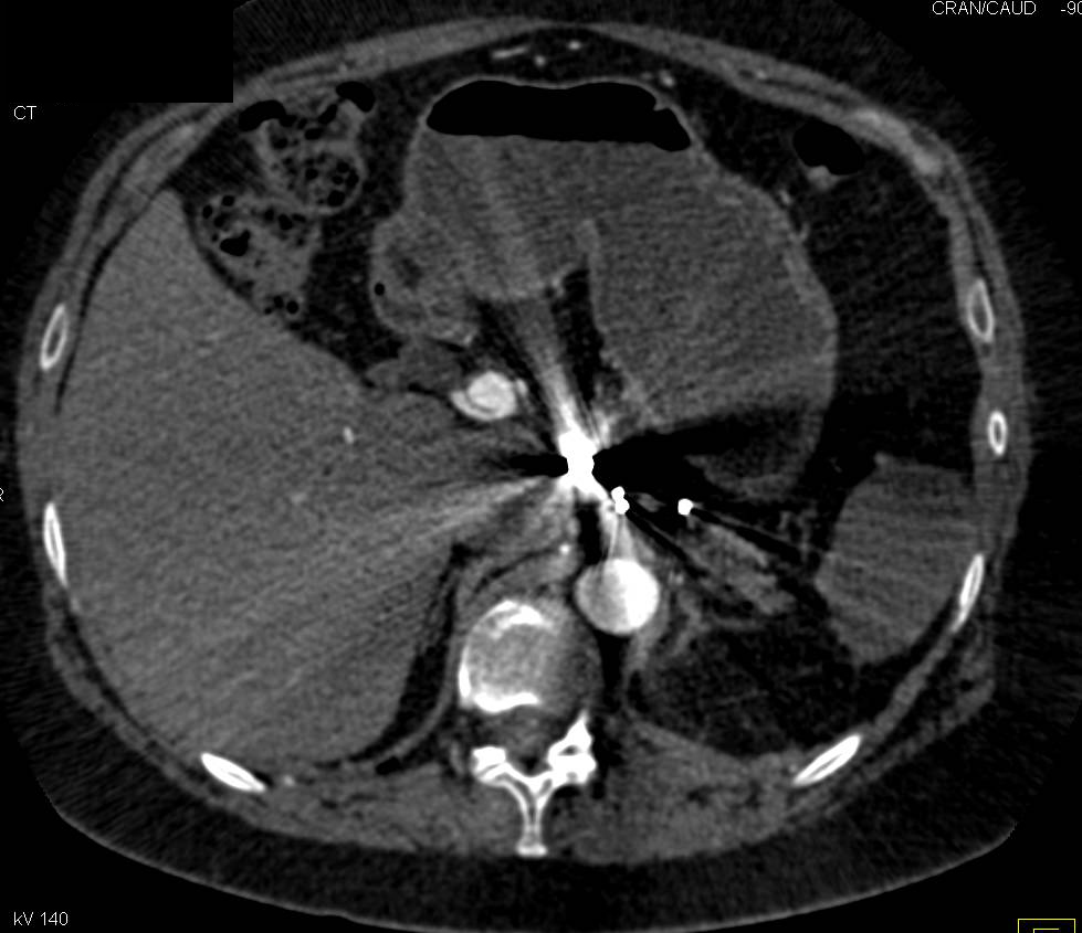 Hepatic Artery Aneurysm - CTisus CT Scan