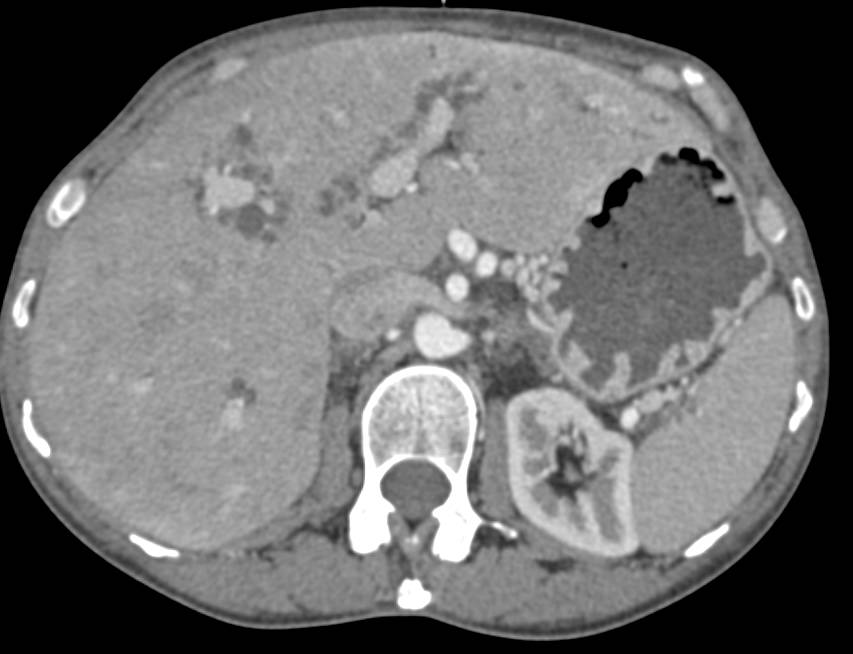 Peribiliary Cysts Liver and Mild CBD/PD Dilatation - CTisus CT Scan