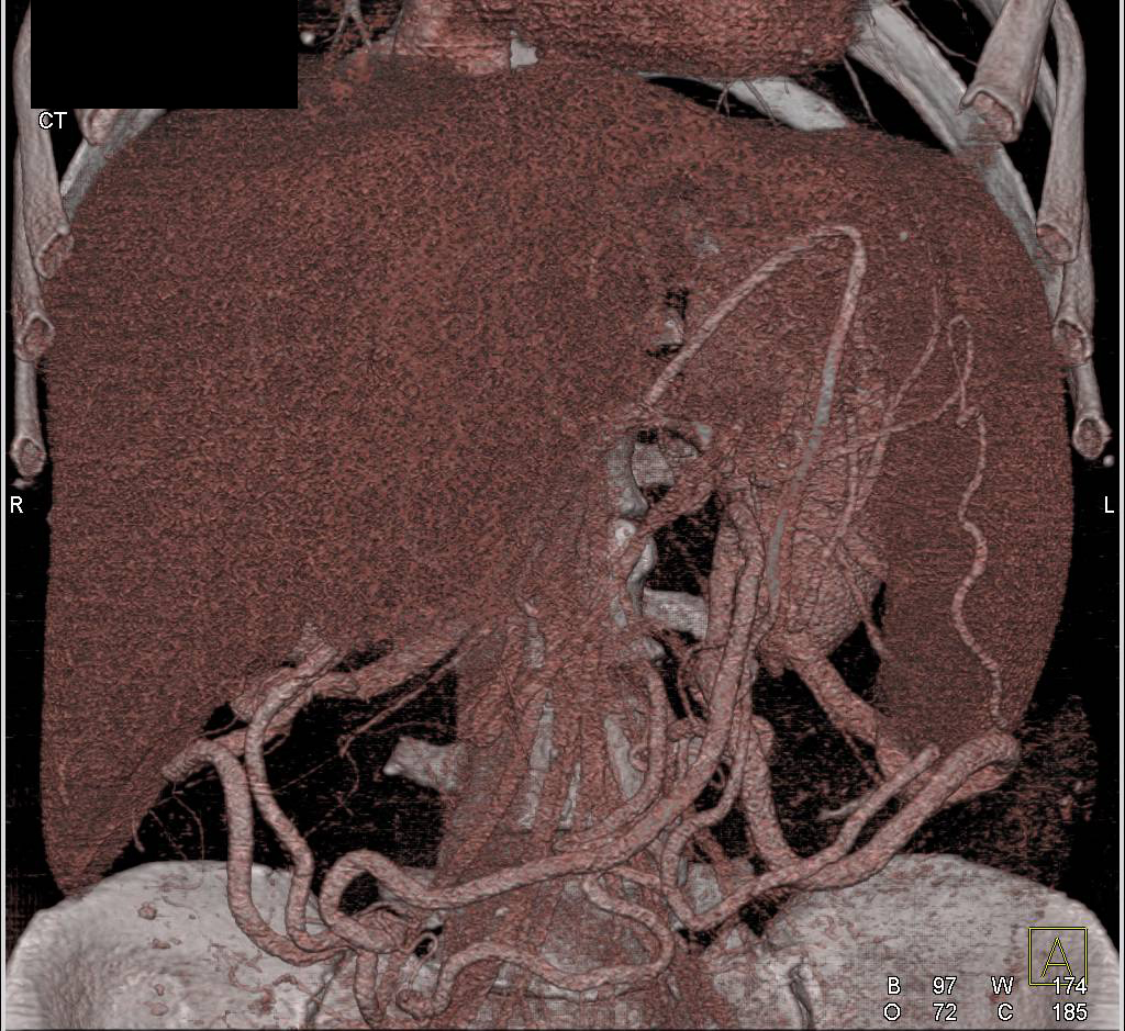 3D of Liver with Collateral Vessels - CTisus CT Scan