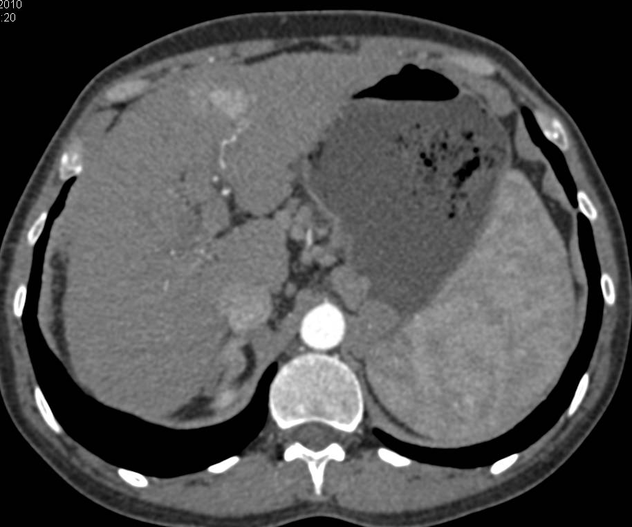 CTA Demonstrates Hepatocellular Carcinoma (Hepatoma) Arising in a Cirrhotic Liver. Note the Changes of Portal Hypertension - CTisus CT Scan