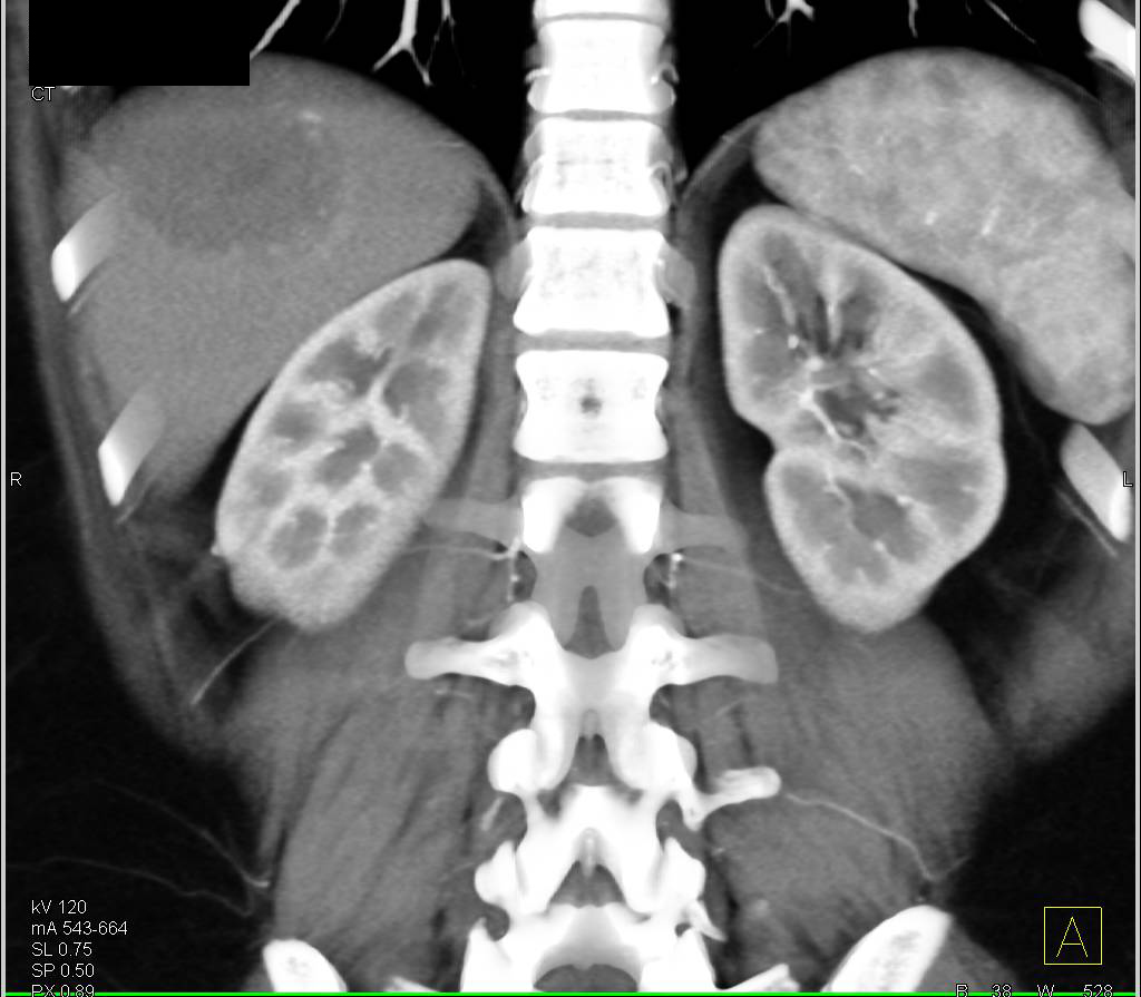 Cavernous Hemangioma - CTisus CT Scan