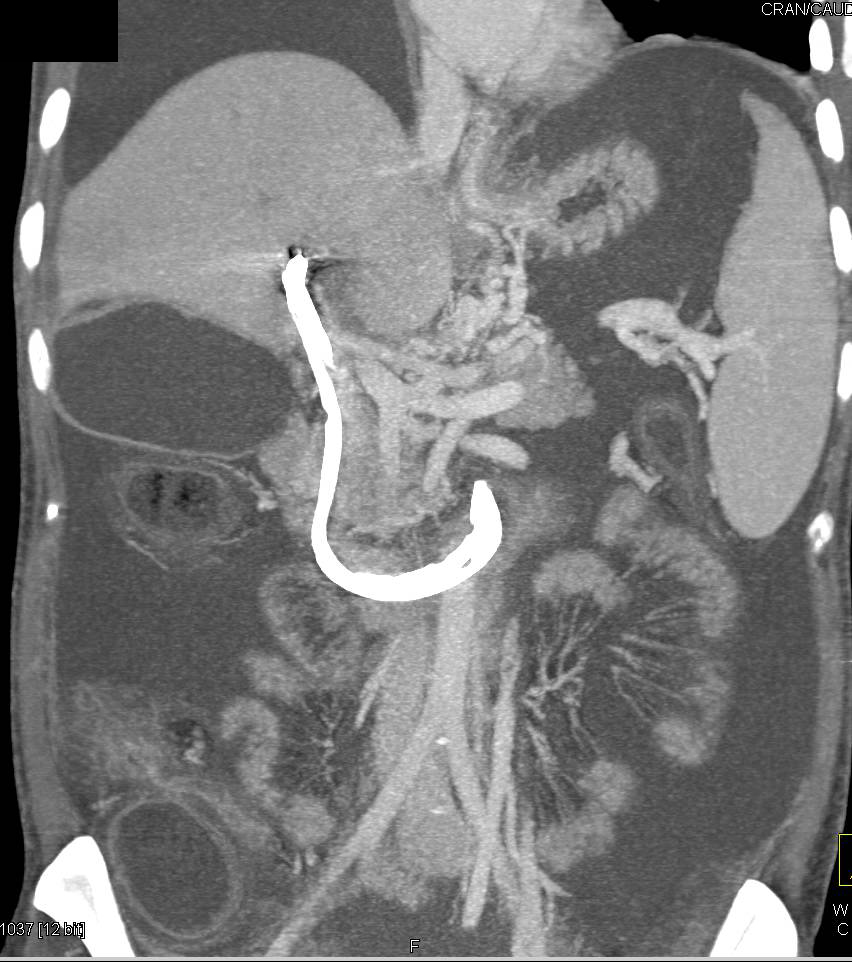 Cholangiocarcinoma - CTisus CT Scan